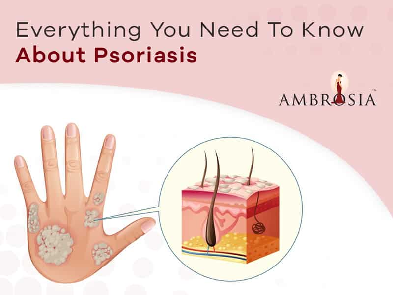 Psoriasis: Symptoms, Types, Causes and Treatment