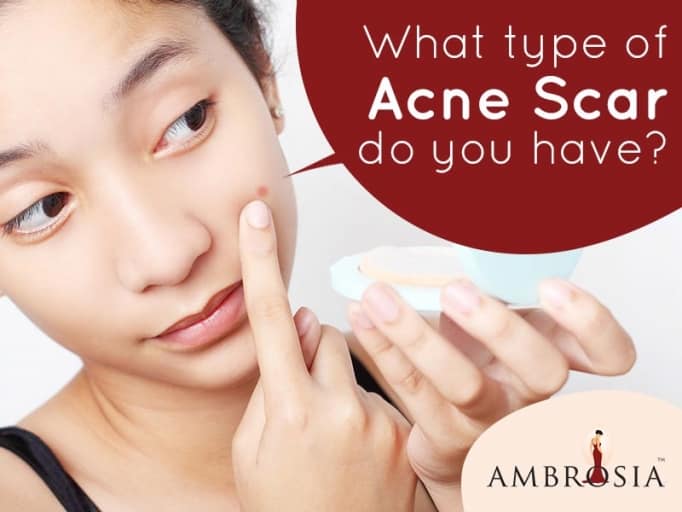 What Type of Acne Scar Do You Have?