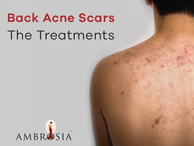 Back Acne Scars – The Treatment