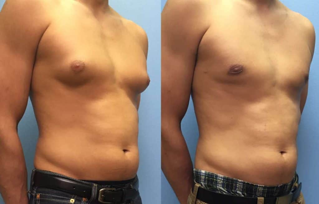 Gynecomastia after and before image
