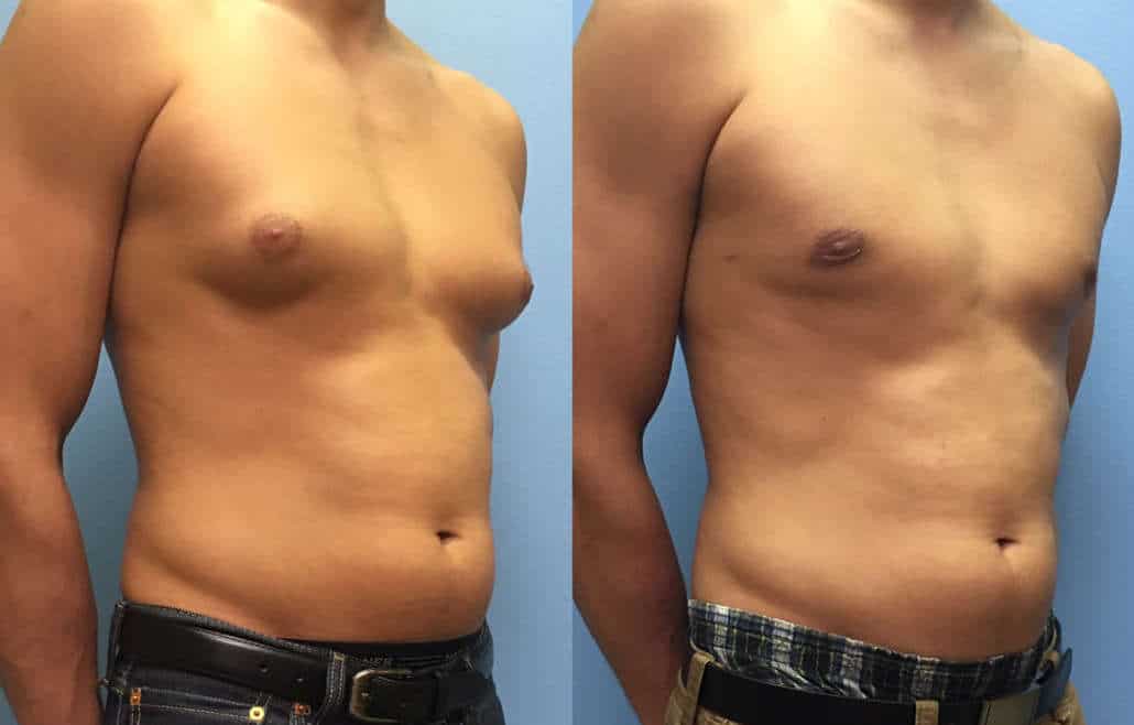 Is Breast Reduction Surgery for Males Effective And Safe?