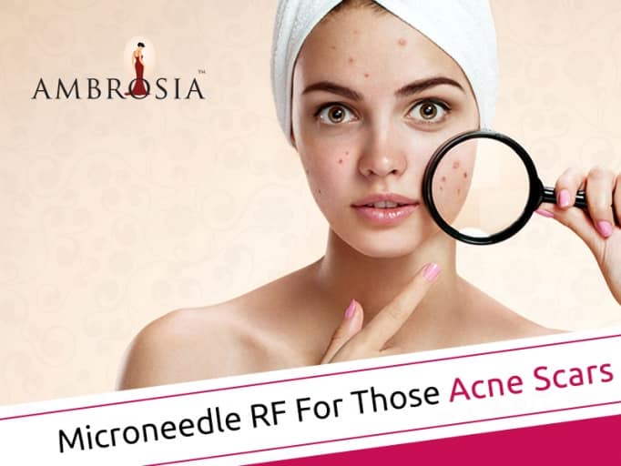 Microneedling For Acne Scars