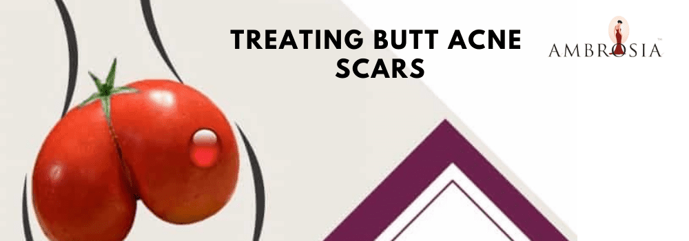 Treat Butt Acne Scars in Hyderabad - Ambrosia Clinic