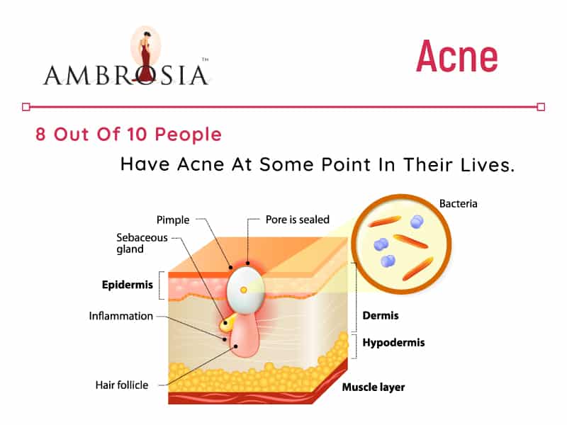 Causes And Treatment For Acne