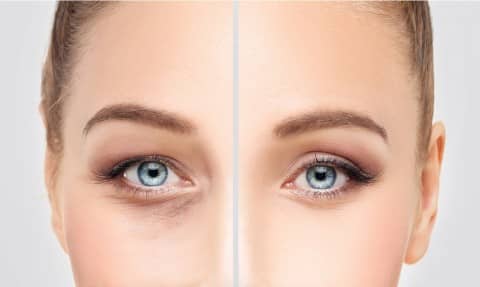 After Fillers Treatment for Undereye