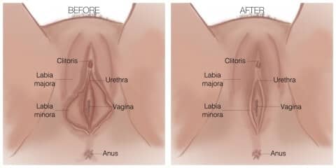 Labiaplasty Results