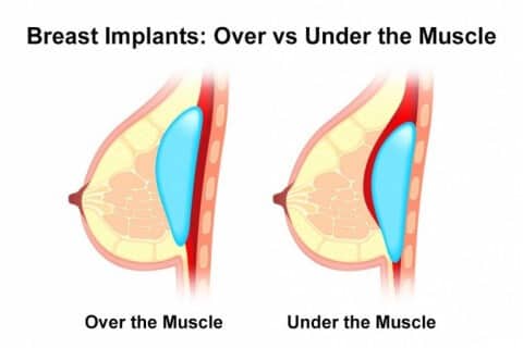 Breast Implant Over Vs Under Muscle