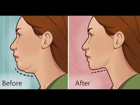 Double Chin Reduction Surgery