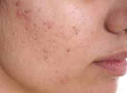 Acne Treatment in Hyderabad