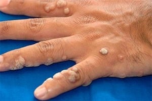 Warts Treatment in Hyderabad