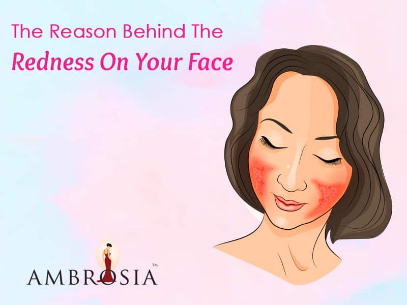 Rosacea: The Reason Behind The Redness On Your Face