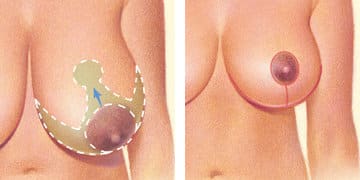 Breast Reduction: Treatment, Procedure, And Results