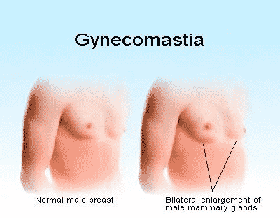 Male Breast Reduction in Hyderabad
