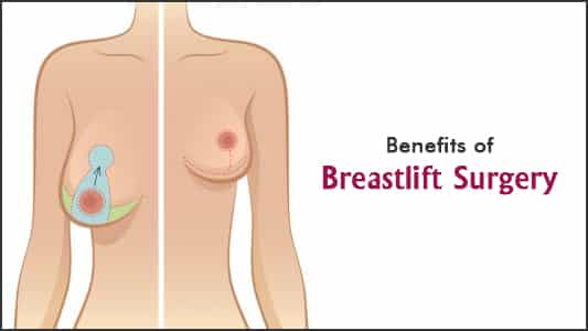 Breast Lift Surgery: Benefits, What To Expect Before And After