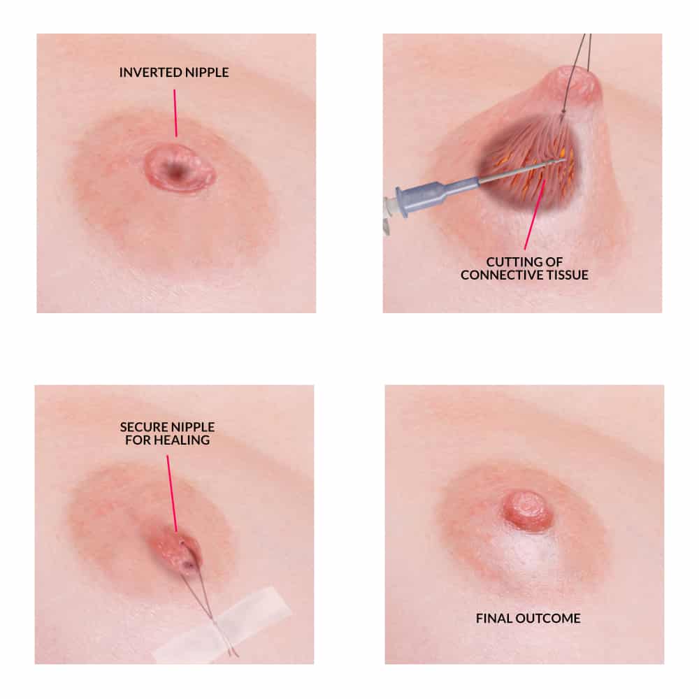 Breast Augmentation with Inverted Nipple Surgery, Post Age 30 - Can it be done?