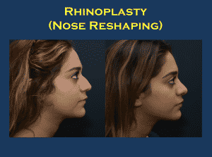 Rhinoplasty Surgery: A Complete Guide to Nose Surgery Benefits, Treatment, Cost and Results 