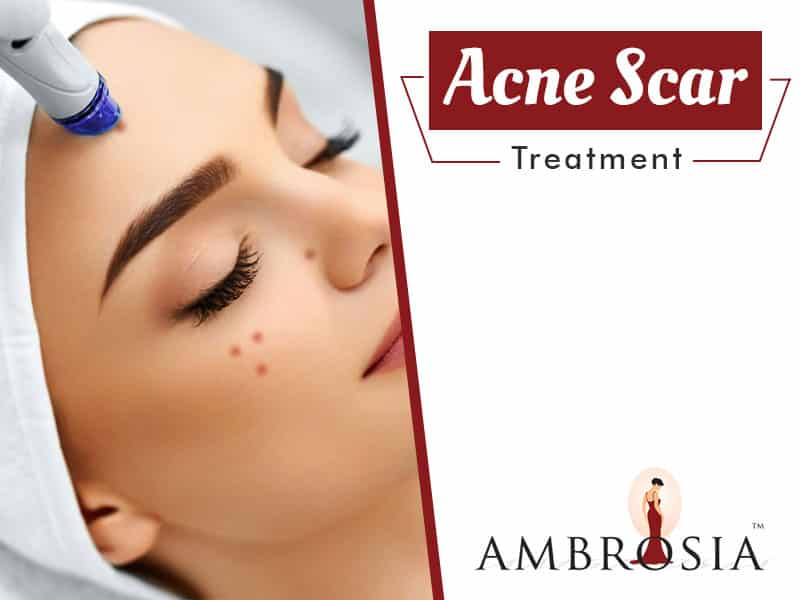 Acne Scar Treatment - Ambrosia Clinic