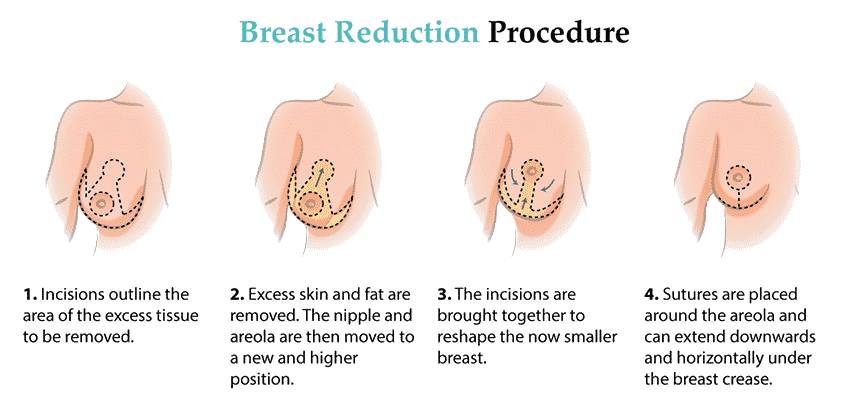 Breast Reduction In India