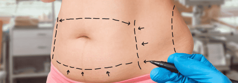 Abdominoplasty Surgery: A Complete Answer Guide To Your Every Question 