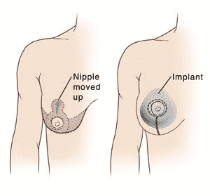 Uneven Breasts? Re-Balance With Breast Lift Or Augmentation