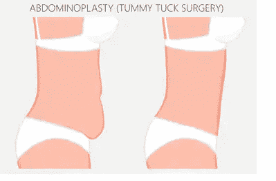 Abdominoplasty Surgery: A Complete Answer Guide To Your Every Question
