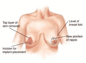 Uneven Breasts Rebalance With Breast Lift Or Augmentation