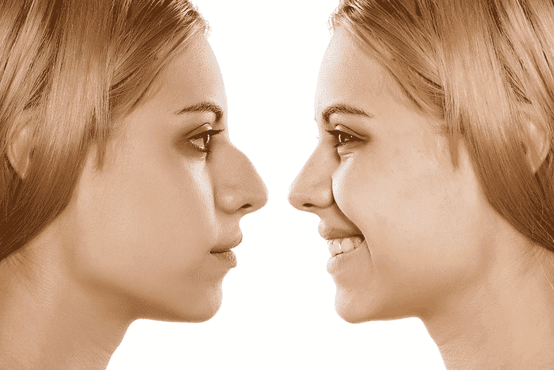 Rhinoplasty Surgery: A Complete Guide to Nose Surgery Benefits, Treatment, Cost and Results 