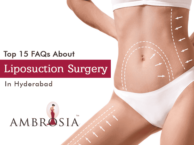 Top 15 FAQ’s About Liposuction Surgery In Hyderabad