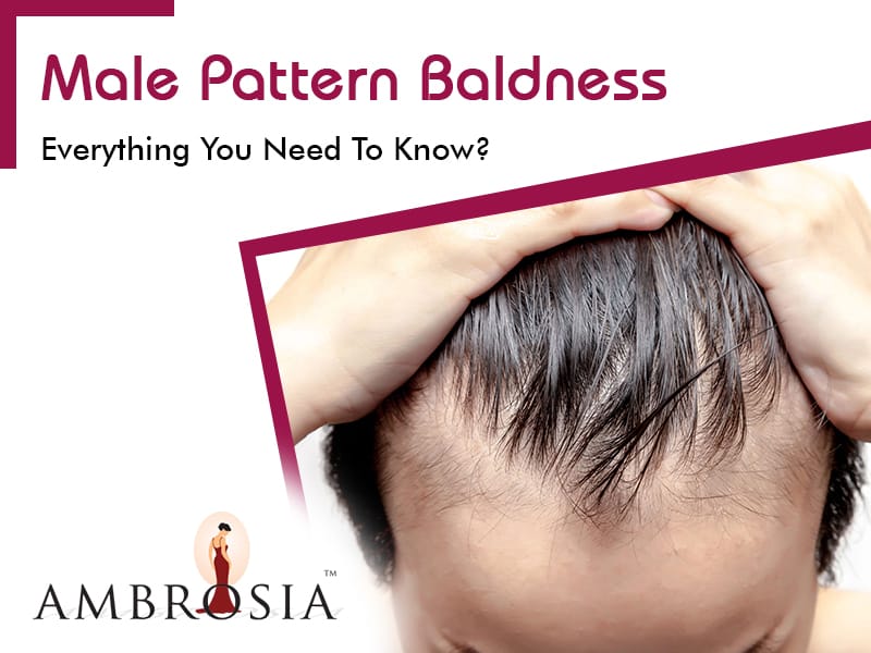 Male Pattern Baldness - Everything You Need To Know?