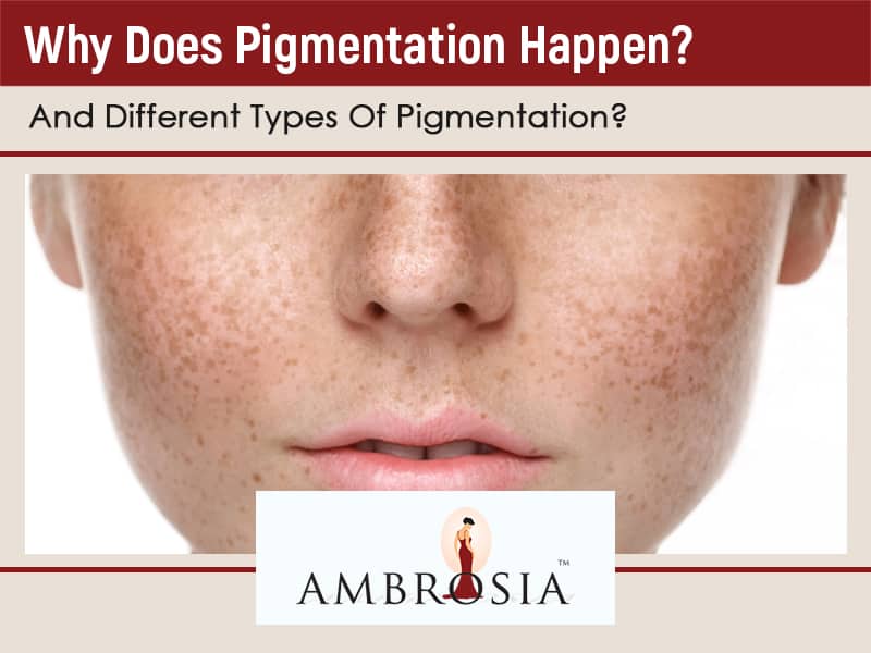 Why Does Pigmentation Happen? And Different Types Of Pigmentation?