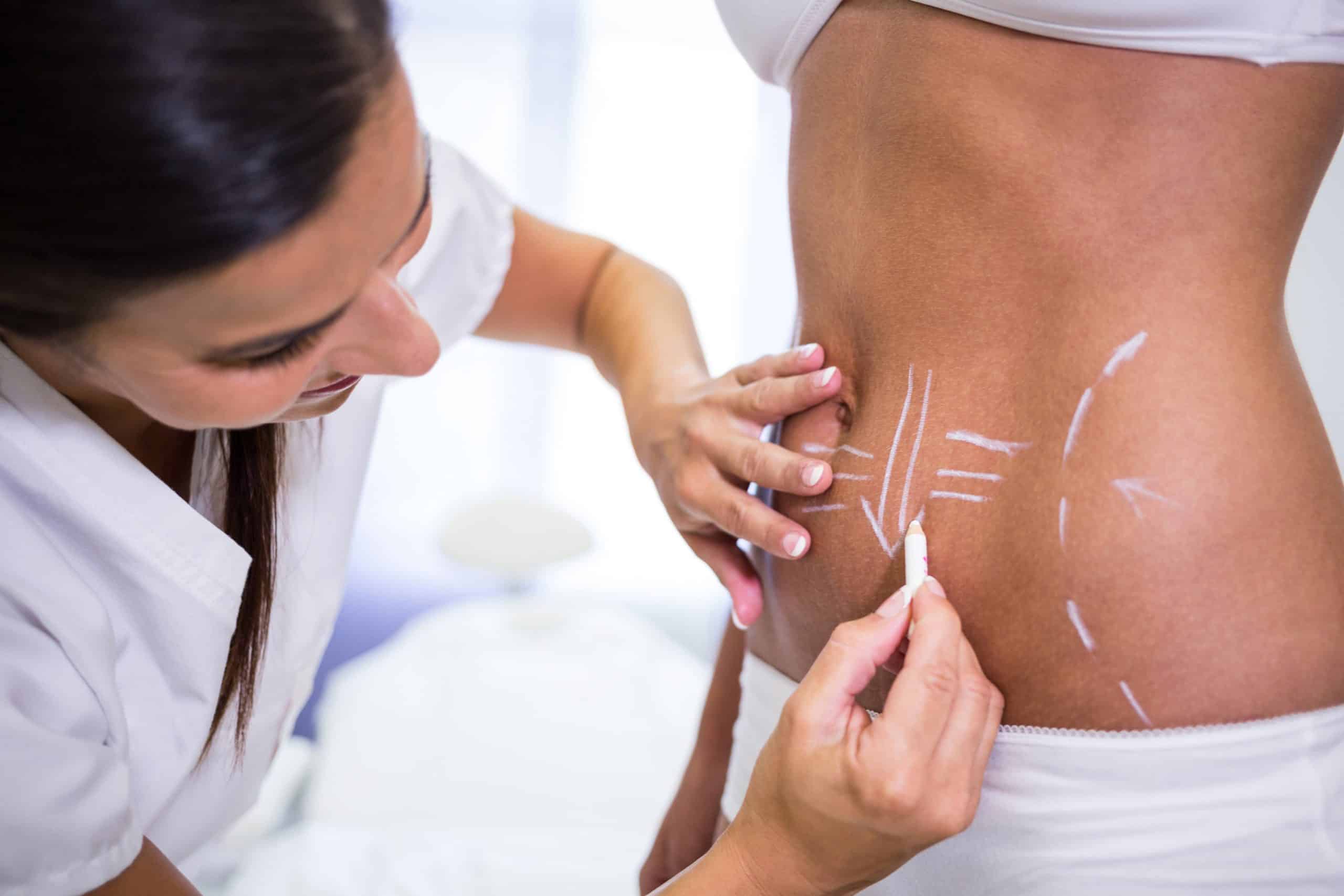 surgeon drawing lines on woman's abdomen for liposuction