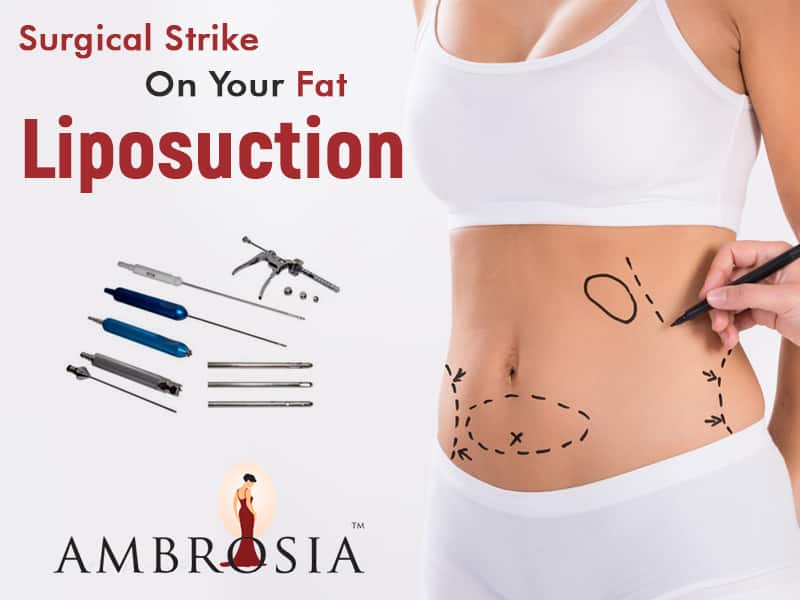 Surgical Strike On Your Fat: Liposuction