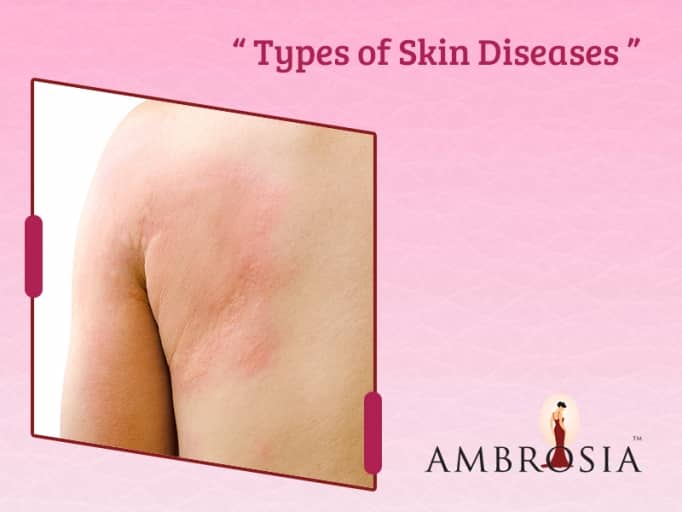 Types of Skin Disorders 