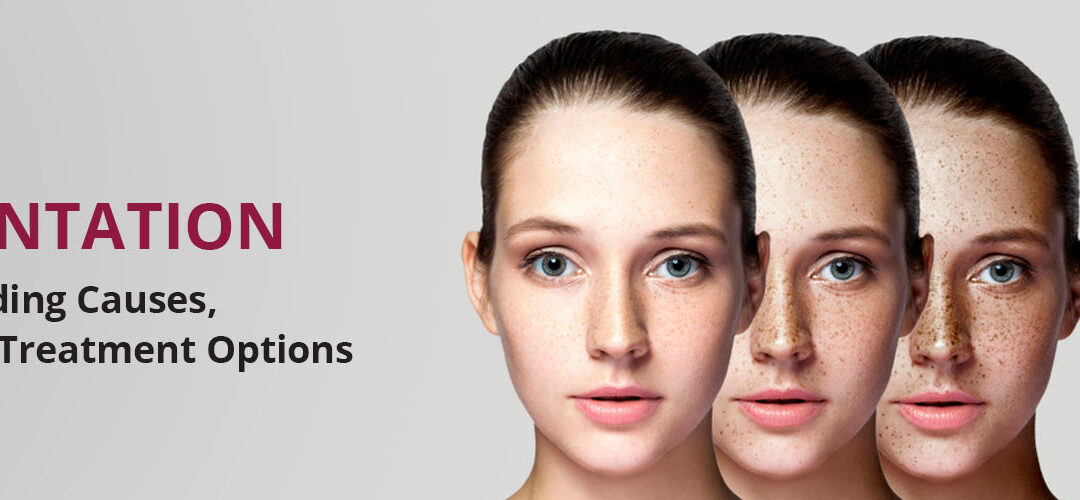 Skin Pigmentation Disorders: Understanding Causes, Types, and Treatment Options