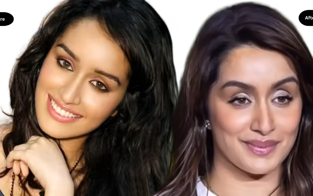Is Shraddha Kapoor’s ‘Botox Look’ Real? Dermatologists Finally Explain